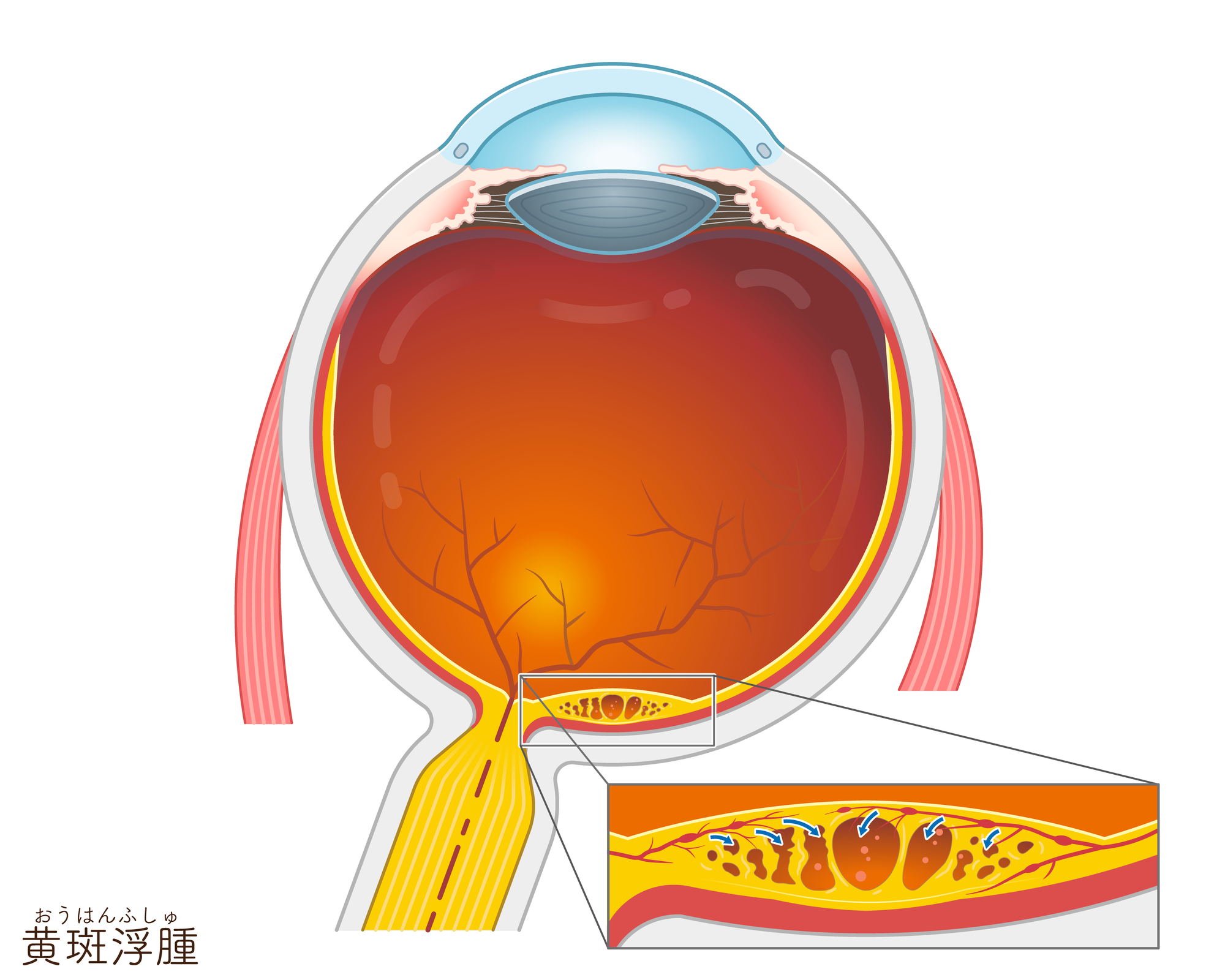 網膜静脈閉塞症
